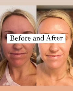 Achieve a More Streamlined, Youthful Chin Profile with Kybella Achieve a More Streamlined, Youthful Chin Profile with Kybella