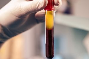 Uses and Benefits of Platelet Rich Plasma Uses and Benefits of Platelet Rich Plasma