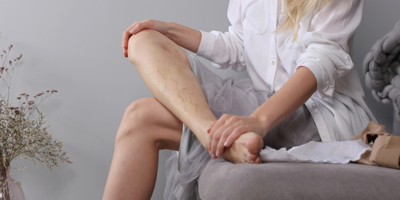 3 Benefits of Sclerotherapy