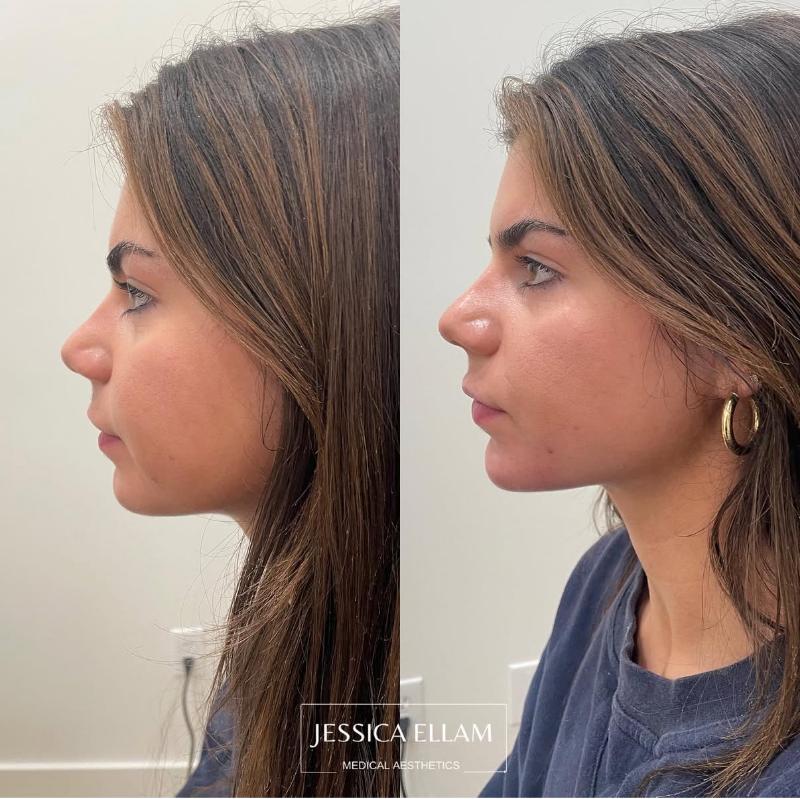 Chin Filler 2