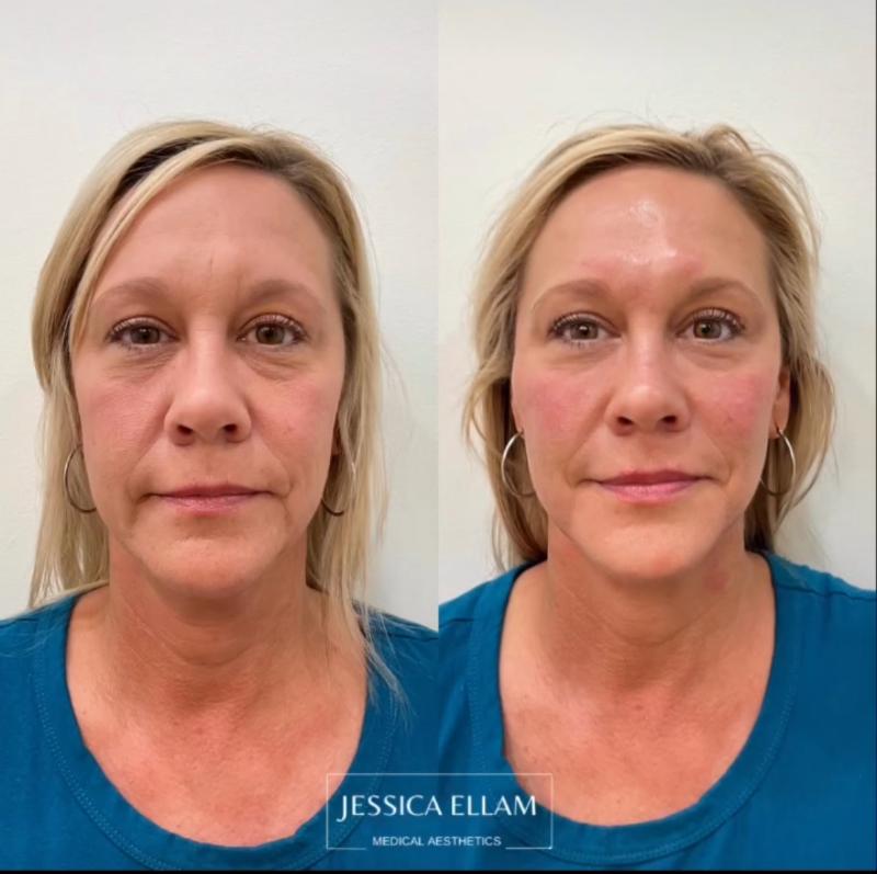 Facial Balancing with HA Fillers