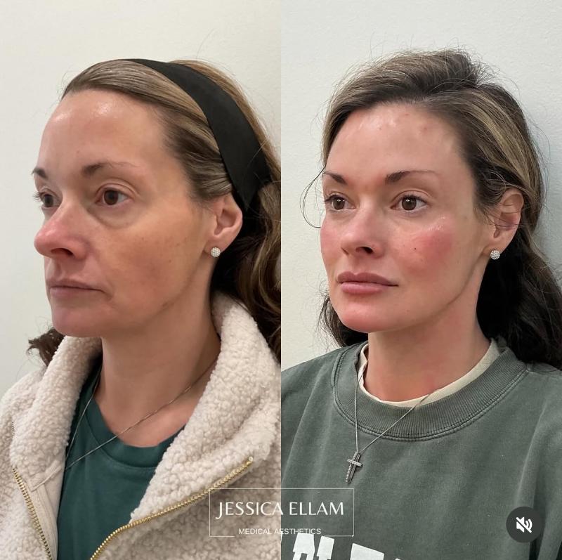 Facial Balancing with Sculptra and HA Fillers