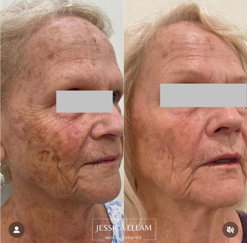 LaseMD Ultra Laser