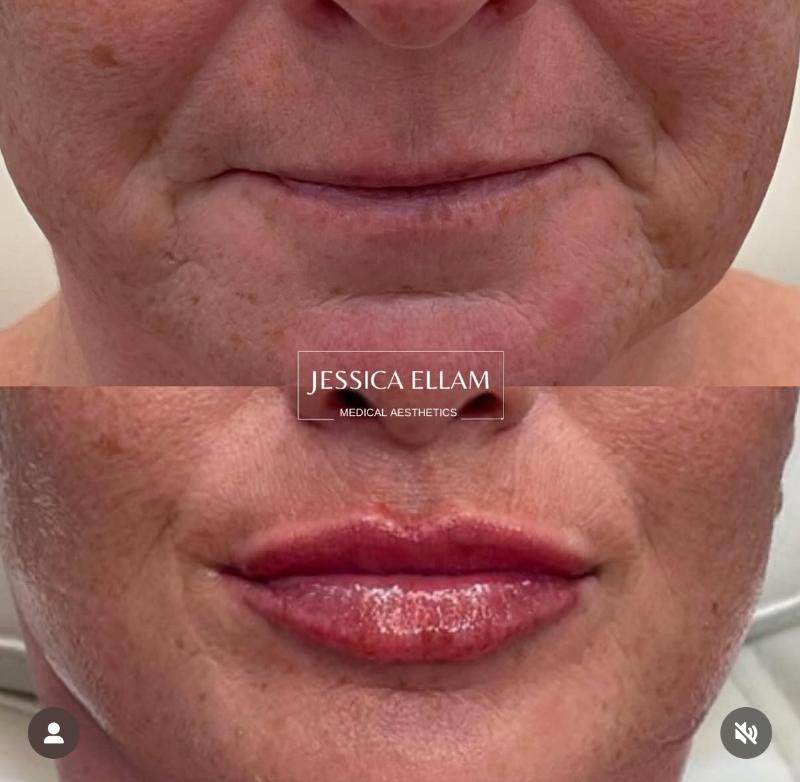 Lip Filler 2