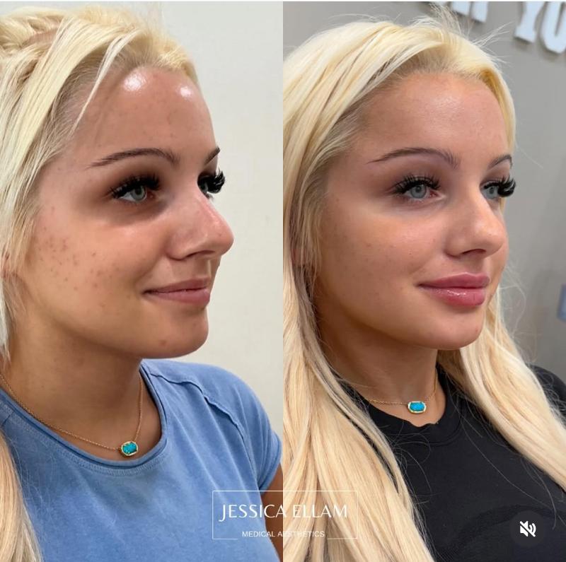 Lip Filler 3