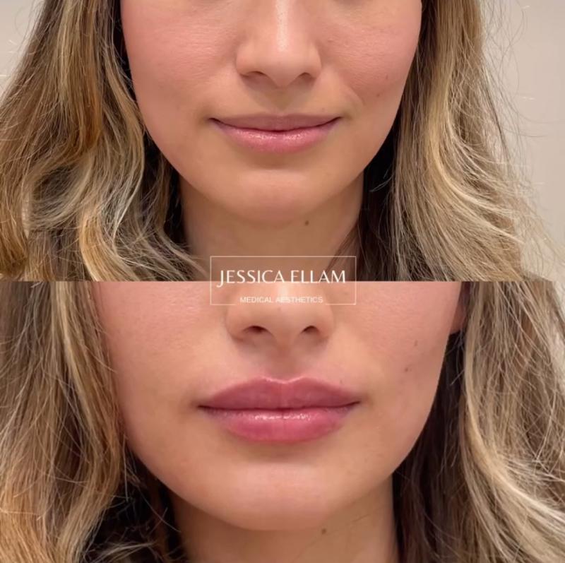 Lip Filler
