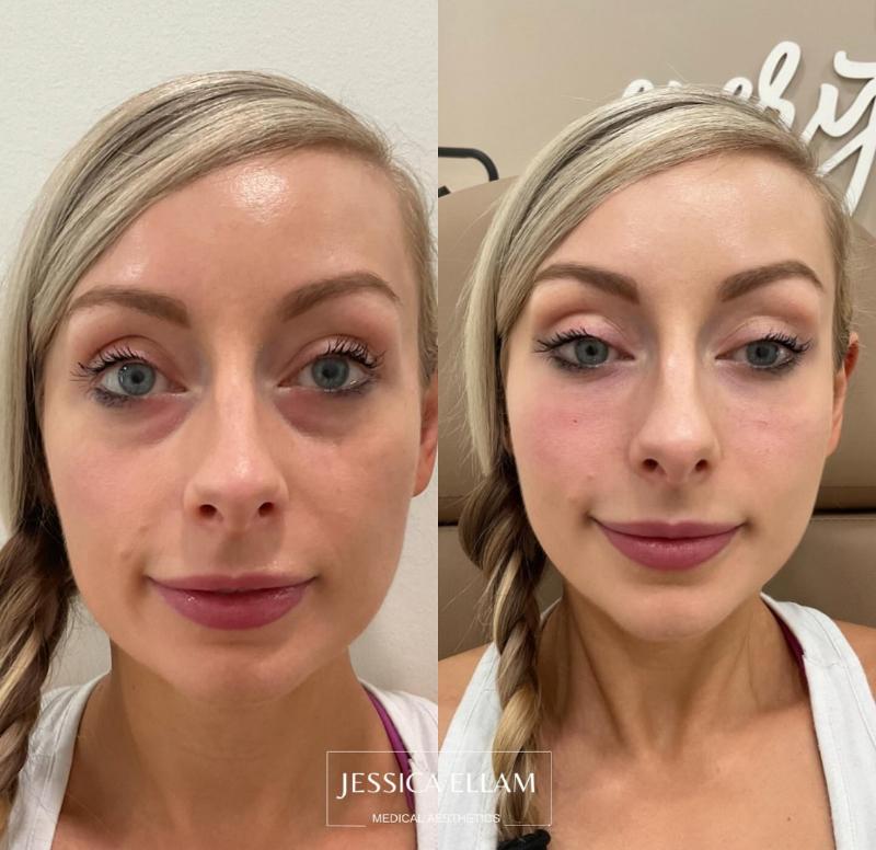 PDGF Under Eyes