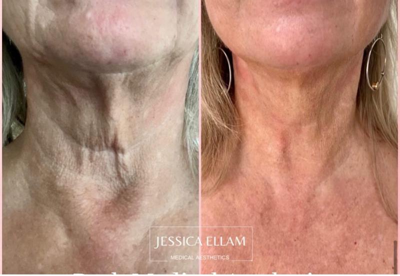 SylfirmX and Hyper Dilute Radiesse for Neck