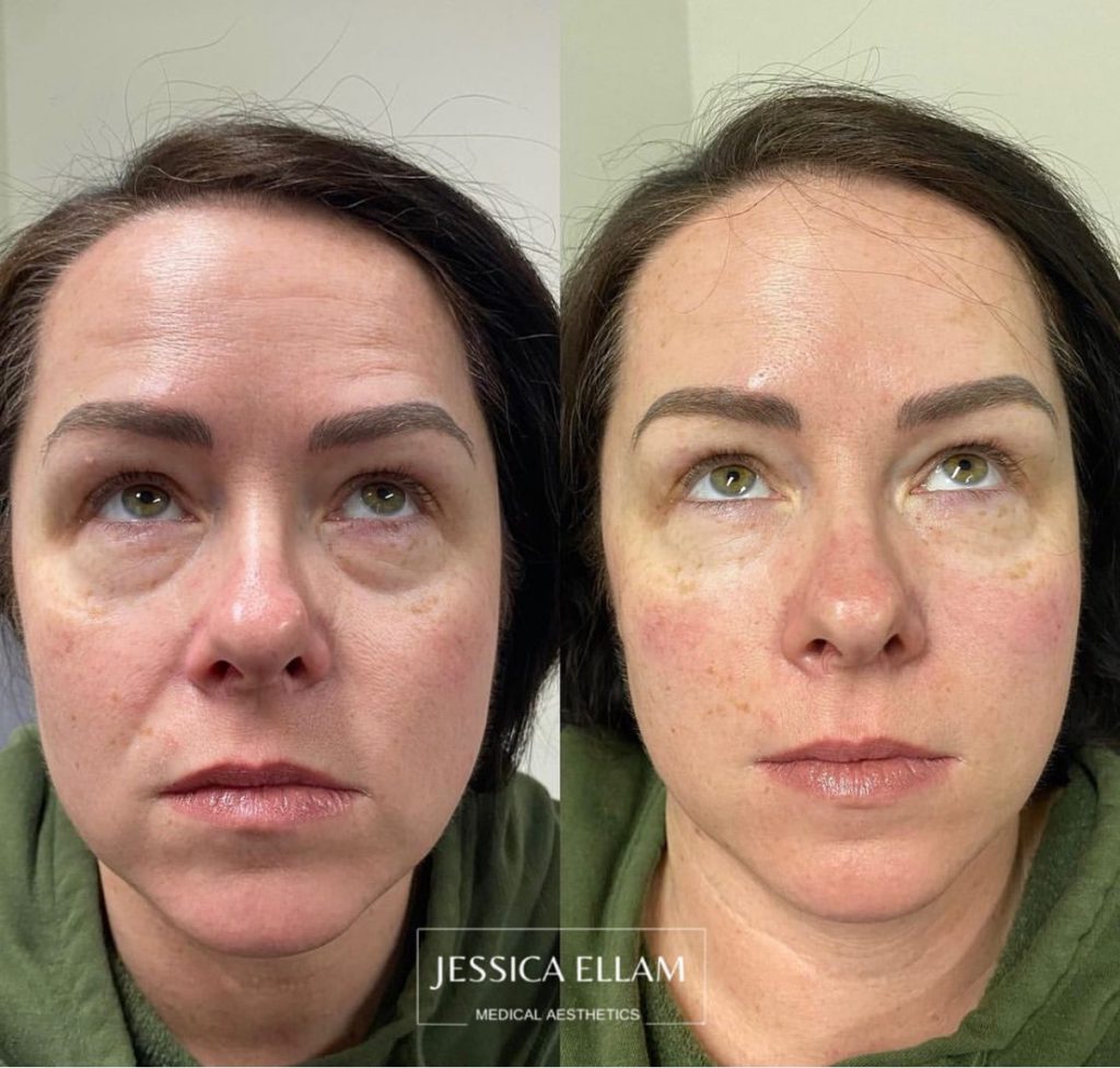 Undereye Refresh