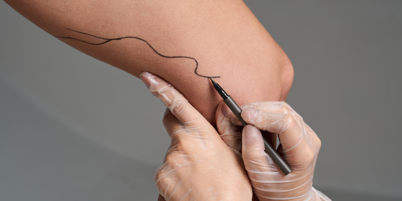 How Sclerotherapy Clears Away Unwanted Spider Veins